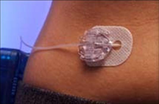 clean site Disconnecting Aside from a pod, sites can easily disconnect leaving the cannula