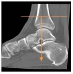 Scan Range: Above tibia/fibula joint through hind foot.
