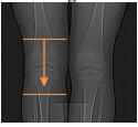Knee: Scan Range: Patient supine, feet first with legs flat on