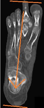 If specific digit or metatarsals is the area of interest, align