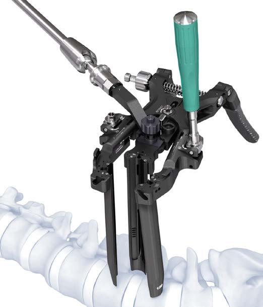 The retractor has to be placed in the zero position as follows (): Close the left and right blades by loosening the speed nut on the retractor body ().