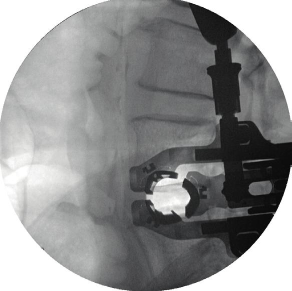 posterior fluoroscopy Low Profile Accessories: In blade embedded accessories maximize surgeon view Winglets to provide further 7 mm anterior/posterior soft tissue