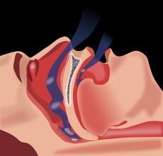 Sleep Apnea Sleep apnea is a common undiagnosed disorder in which you have one or more pauses in breathing or shallow breaths while you sleep. Breathing pauses can last from a few seconds to minutes.