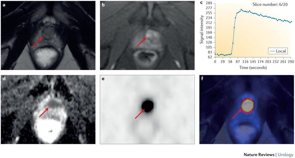 Figure 2 68 Ga-PSMA PET MRI of a 50-year-old patient who had a rising serum PSA value (16 ng/ml at imaging) and two tumour-negative