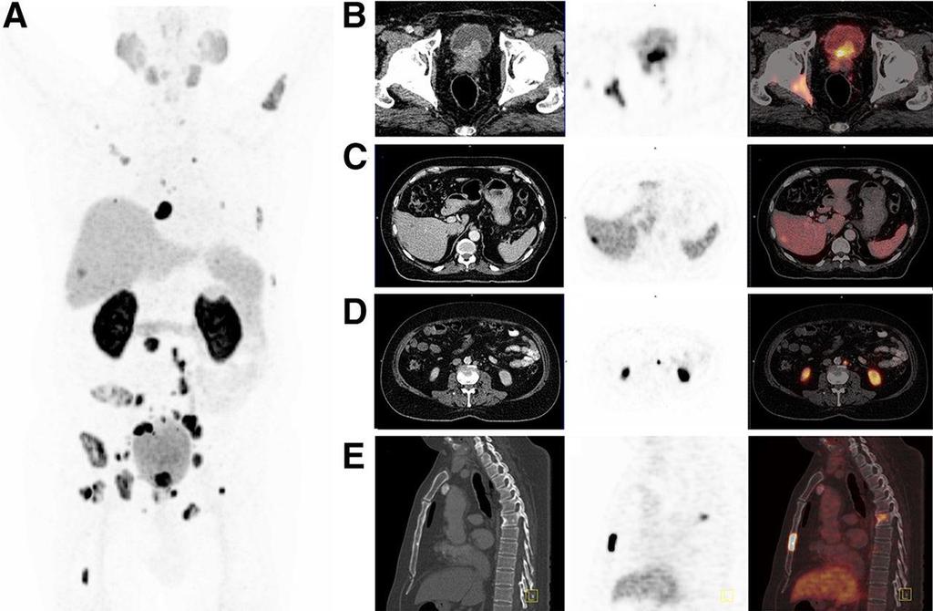 68Ga-PSMA I&T PET/CT of patient 1. Martina Weineisen et al.