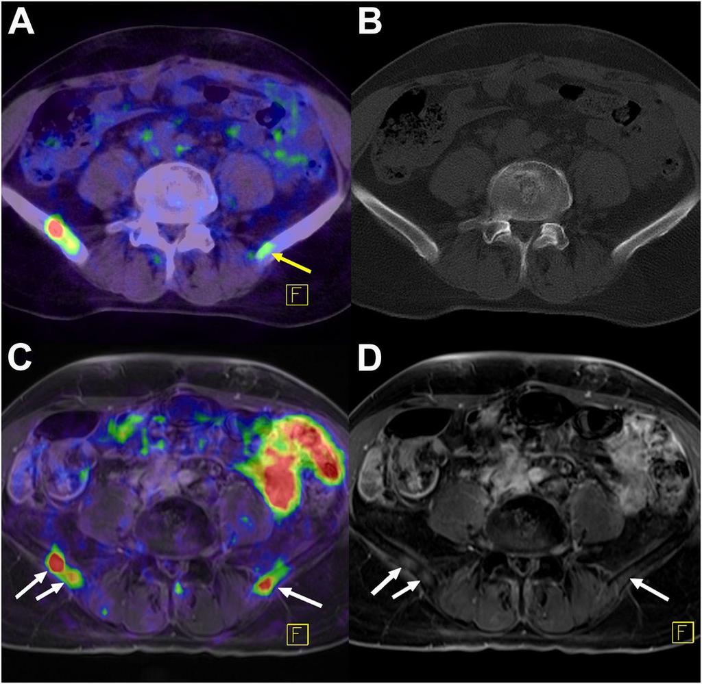 68Ga-PSMA-11 PET/CT (A and B) and PET/MRI (C and D) of patient with recurrent PCa.