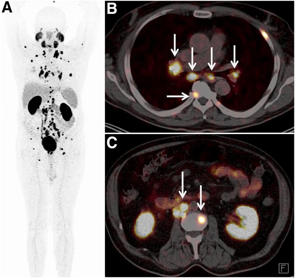 First-in-human 68Ga-SRV171 PSMA PET/CT imaging demonstrating extensive and excellent tracer uptake in soft-tissue (lymph node) and