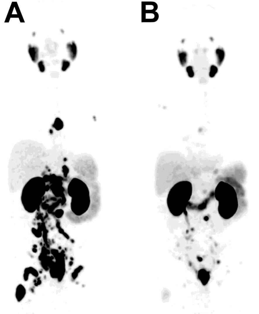 68Ga-PSMA-11 PET/CT of patient before (A) and 3 mo after (B) 1 cycle of 131I-MIP-1095.
