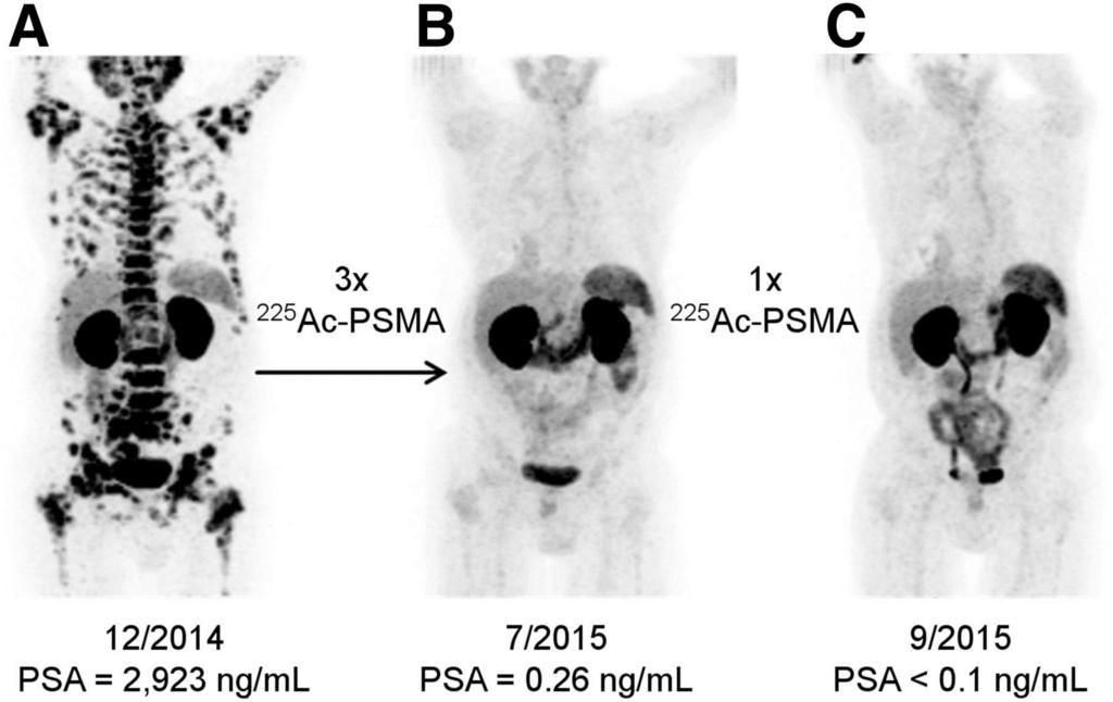 68Ga-PSMA-11 PET/CT scans of patient A.