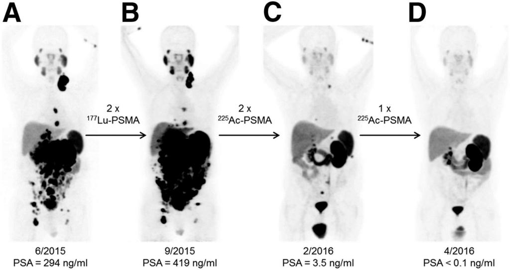 68Ga-PSMA-11 PET/CT scans of patient B.
