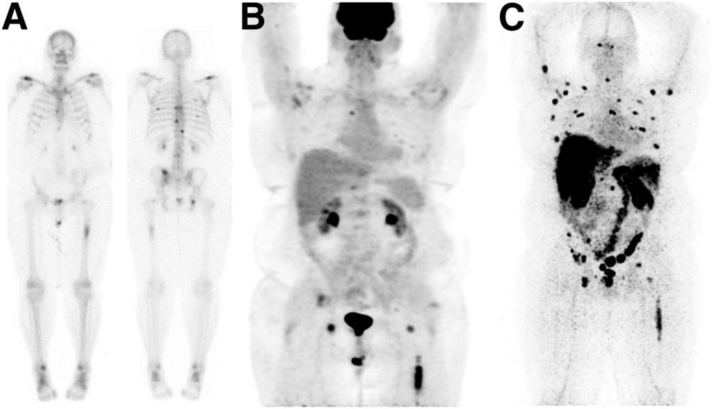 Lesion targeting with 89Zr-IAB2M in mpc patient. Neeta Pandit-Taskar et al.