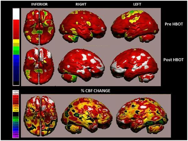 Figure 1. Volume rendered Brain SPECT perfusion maps of Example 1, a 51-year-old woman from the treated group suffering mtbi that had occurred 2 years prior to inclusion in the study.