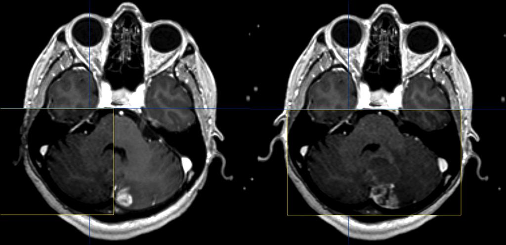 Radiological monitoring : T1 contrast- enhanced MRI images