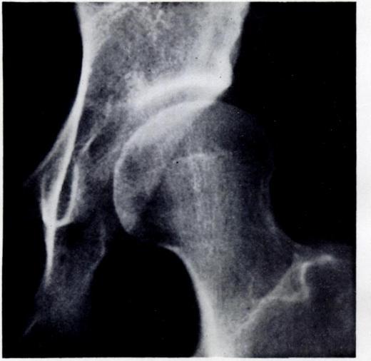 28 E. w. SOMERVILLE after treatment. A number then deteriorated between Table VI. Results at fiveyear intervals after treatment in 90 hips ten and fifteen years.