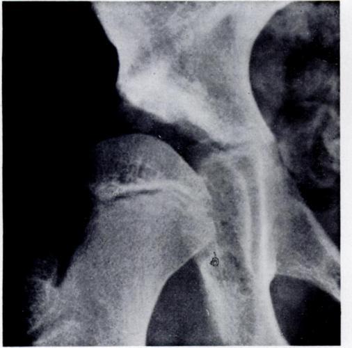 deterioration over more than twenty years. This is a stable hip and may continue thus for a very long time.