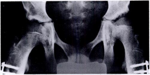 Figure By the age of fourteen the hip had subluxated and the acetabulum was damaged beyond spontaneous