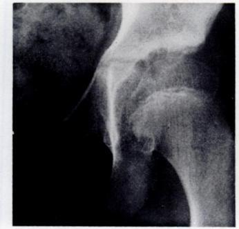 30 E. W. SOMERVILLE Fig. 15 Fig. 16 Fig. 17 Figure 15The radiograph of a left hip taken at the age of five, two years after treatment of a dislocation.