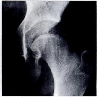 The problem is to ensure that the hip will grow properly throughout the whole period of growth and will remain functionally normal afterwards.