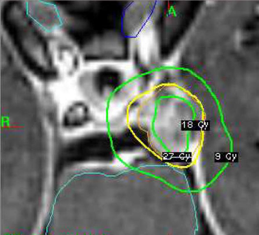 It is delineated on a post-gadolinium T1-weighted MRI (left) and a Gamma Knife radiosurgery plan to deliver 18 Gy in a single fraction prescribed to the 50% isodose is demonstrated on the right.
