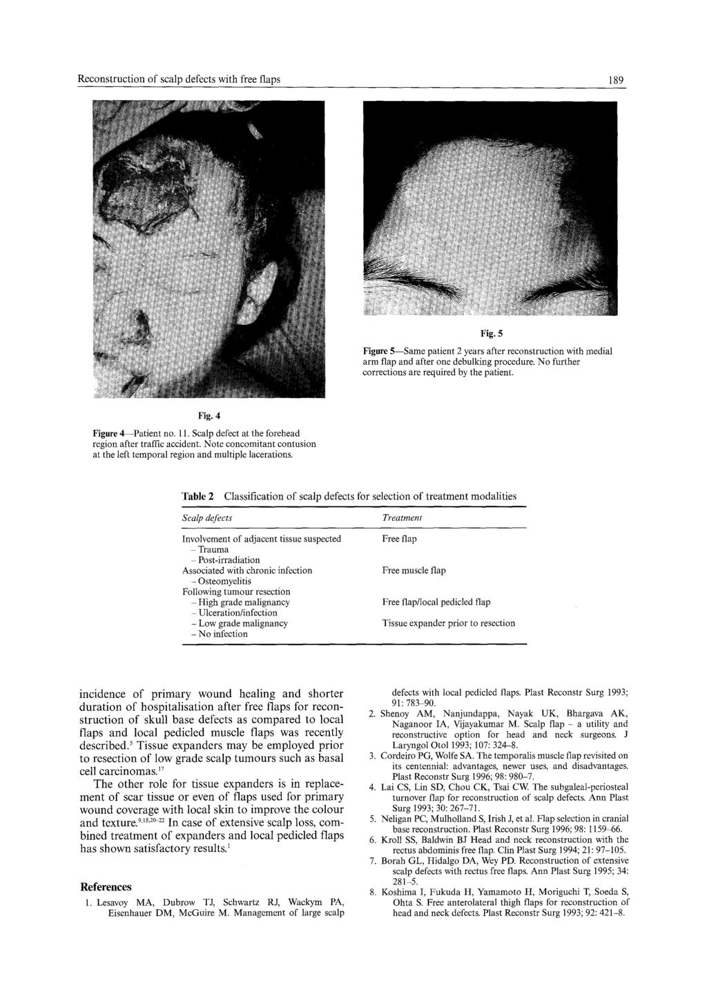 Reconstruction of scalp defects with free flaps 189 Fig. 5 Figure 5--Same patient 2 years after reconstruction with medial arm flap and after one debulking procedure.
