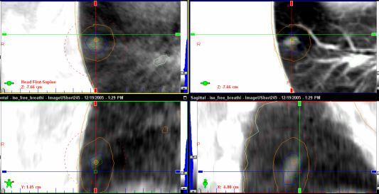 Fluoroscopy (X-Ray/CBCT) Cine-MV, X-Ray X-Ray/CBCT Free-breath 3D CBCT Match Planning CBCT Post-treatment