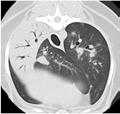 Consolidated Lung (Pulmonary Blood Vessels Obscured) Without air bronchograms With air bronchograms