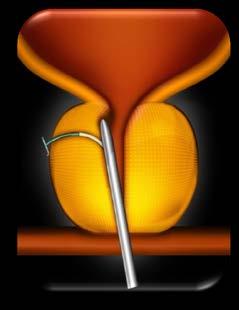 Prostatic Urethral Lift (UroLift