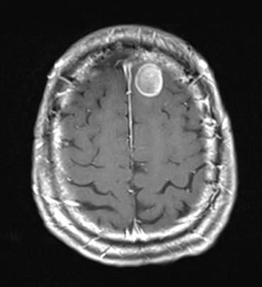 Durable Brain Responses in 2 Patients