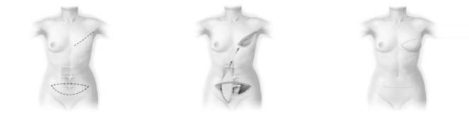11859-00 34 After the tissue expander is removed, the breast implant is placed in the pocket. In reconstruction following mastectomy, a breast implant is most often placed submuscularly.