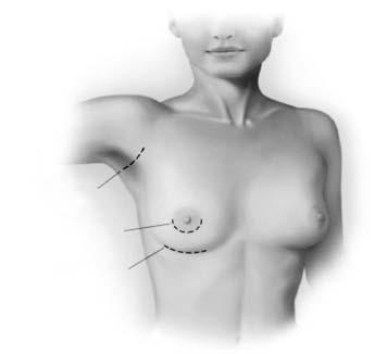 33 11859-00 Periareolar - This incisiohin is typically more concealed, but since it also involves cutting through the breast tissue, it is associated with a higher likelihood of breast feeding