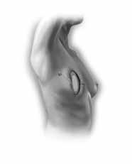 14 10647-01 What Is the Breast Implant Reconstruction Procedure?