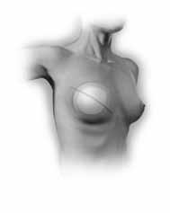 After the general surgeon removes your breast tissue, the plastic surgeon will then implant a breast implant or an expander/breast implant (BECKER Expander/Implant) that completes the one-stage