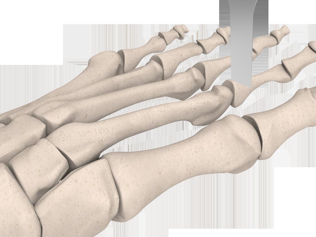 Surgical Technique Step One: Locate the metatarsalphalangeal joint by dorsiflexing and in particular, plantarflexing the proximal phalanx on the head of the metatarsal.