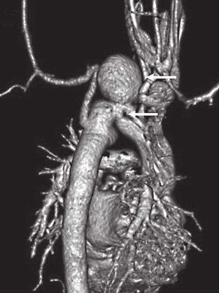 Gadolinium-enhanced magnetic resonance angiography (B, C). Bicuspid aortic valve was present in 63 85% of the patients with coarctation of the aorta [5, 8]. We noted that 76.