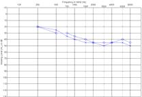 Frequency Compression Candidates Corner audiogram High frequency loss Most configurations Children with Mild-Moderate Hearing Loss Most frequent production errors in children are /s, S, ts/
