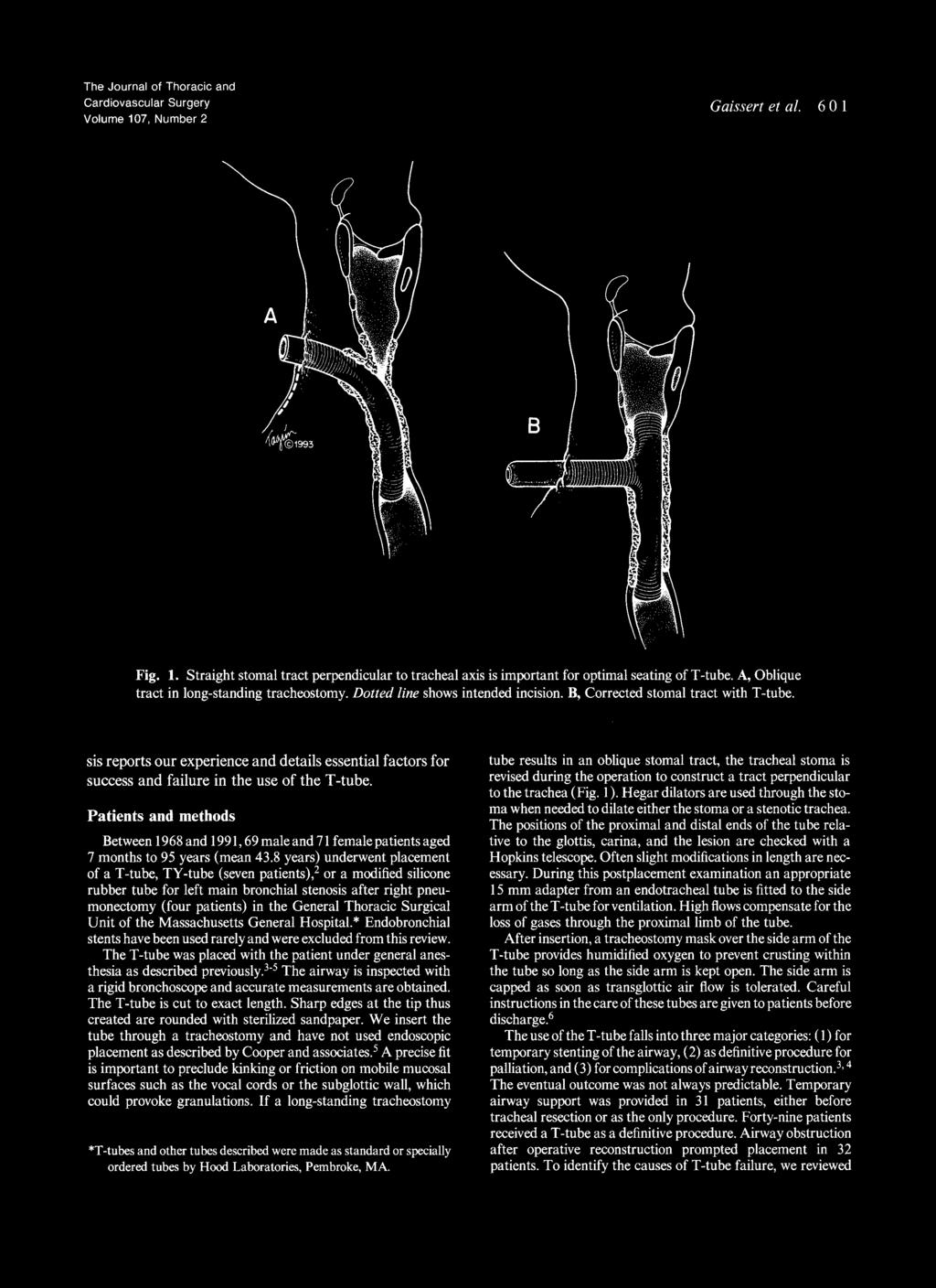 The Journal of Thoracic and Volume 107, Number Gaissert et al. 6 0 1 Fig. 1. Straight stomal tract perpendicular to tracheal axis is important for optimal seating of T -tube.