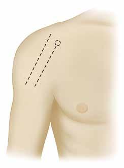 SURGICAL APPROACH Figure 1 Surgical Approach SURGICAL APPROACH An anterior deltopectoral incision is made beginning inferior to the clavicle and passing over the coracoid process and extending