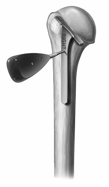 HUMERAL HEAD RESECTION Figure 4 Humeral Head Sizer Head Size (mm) Glenoid Curvature 38 41 44 47 50 53 Alpha Beta Figure 3 Fixed Angle Cutting Guide Table 1 Relationship