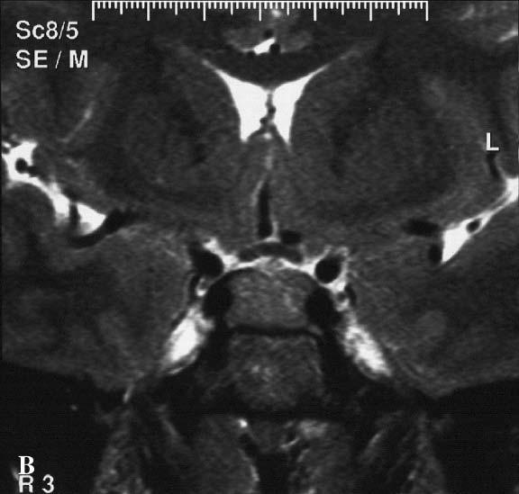 38,51 Sjögren syndrome, 48 and lymphocytic parathyroiditis. 52 Xanthomatous Hypophysitis Only a few cases of xanthomatous hypophysitis have been reported.