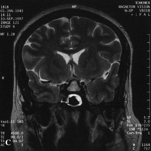(D) Sellar plain x-ray showing ballooning of the sella, erosion of the dorsum, and posterior clinoids. (E) Enlarged pituitary with is noted in the sagital contrast enhance image.