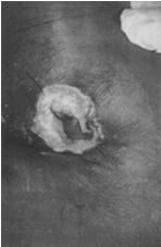 9/5 (NN) buttocks ulcer found, treated using protocols 9/6 (NN) stage III on right buttock, 5 x 3 cm, 85% red, 10% yellow, 5% black 9/7 (NN)