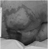 diseases Pyoderma Calciphylaxis End