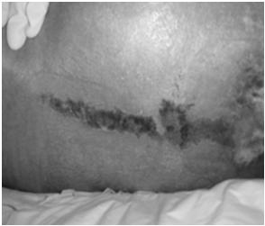 turn the patient Same is true for other personal cares If hospital pillows are thin, when combined with inadequate turning Leads to stripe appearance to