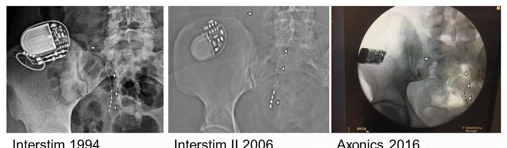 Blok Interstim 1994 Interstim II 2006 Axonics 2016 Figure 2. Anterior fluoroscopy view of implanted the three marketed sacral neuromodulators and the year of obtaining CE Mark.
