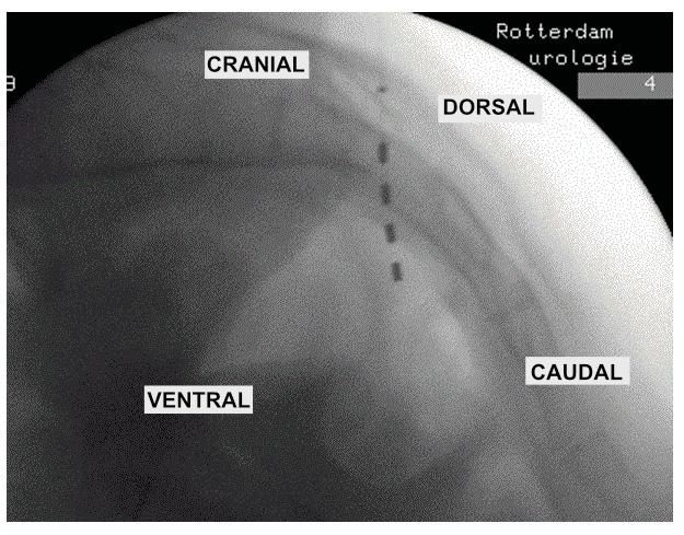 Sacral neuromodulation Review CRANIAL DORSAL VENTRAL CAUDAL Figure 3. Lateral fluoroscopy view of the permanent tined quadripolar lead in the third sacral foramen.