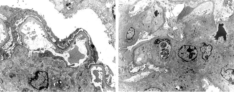RAGE DELETION PRESERVES FUNCTION IN NEPHROPATHY IN A x6 B x4 C x6 D x6 E x6 F x5 GBM GBM FP FP G x4 H x2 L FIG. 2. Histology and ultrastructural pathology in diabetic OVE mice: age 7 months.
