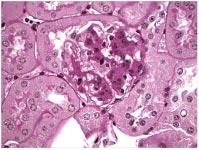 glomerulosclerosis (D). There is focal tubular atrophy, interstitial fibrosis, and chronic inflammation (B).