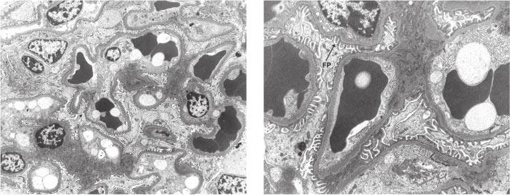 By comparison, glomeruli display increased mesangial matrix forming focal nodules, thickened glomerular basement membranes, and prominent foot process effacement (B).