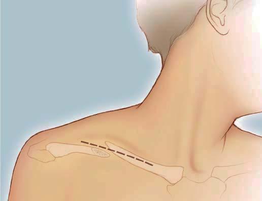 Surgical Technique 2 Approach The horizontal incision is placed over the superior or inferior clavicle, depending on the