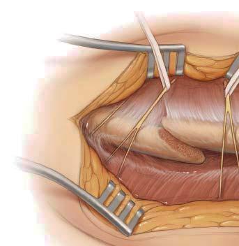 Subcutaneous dissection is performed carefully as it may permit the identification of the perforating supraclavicular sensory